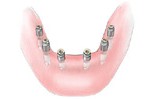 denture-5