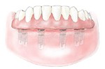 denture-6