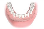 denture-8