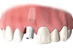 After healing, an abutment is attached to provide the core of the replacement tooth.