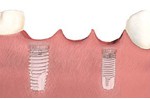 The implant posts are placed and allowed to bond to the surrounding bone and heal in the same manner as single tooth implants. 