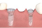 After the appropriate healing time, temporary abutments are placed to allow contouring of the tissue. 