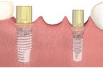 The final step requires the removal of the temporary abutments and the placing of permanent abutments which function as the core of the replacement teeth. 